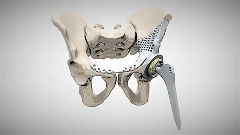 Metal 3D Printing in Medical: 8 Personalized Healthcare